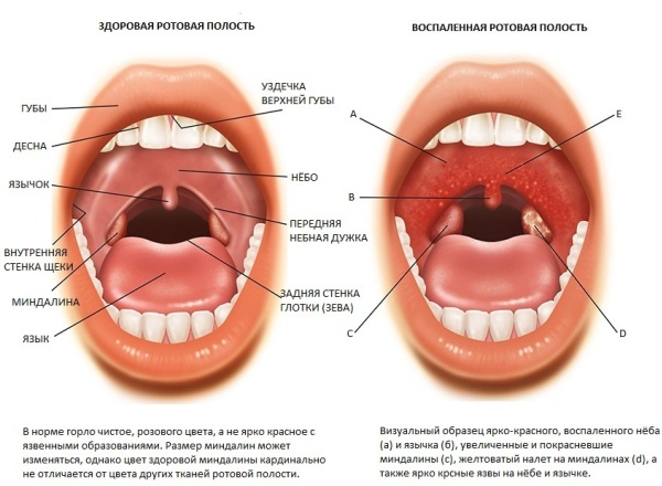 Постоянно Воспаленные Миндалины